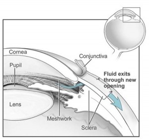 Grüner Star Operation