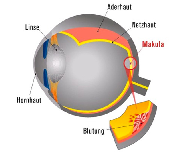 Makula feuchte AMD